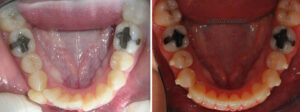 Los dientes de la paciente antes y después del uso de Invisalign
