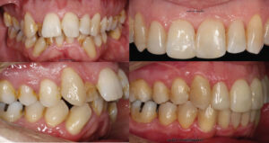 Antes y después de los dientes del paciente tras el tratamiento con Invisalign