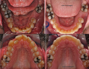Cambios en la dentadura del paciente antes y después de someterse al tratamiento Invisalign