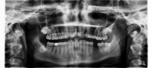 Radiografía en la que se pueden ver los dientes perdidos