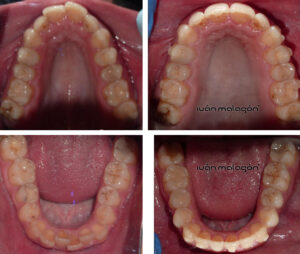Cambios en las arcadas dentales de la paciente antes y después de utilizar la ortodoncia invisible Invisalign