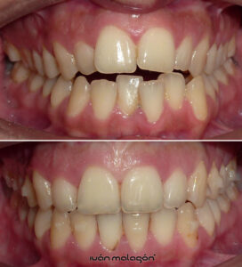 Cambios en los dientes de la pacientes y después del uso de la ortodoncia invisible Invisalign