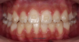 Aspecto de la dentadura de la paciente después de someterse al tratamiento de ortodoncia invisible Invisalign
