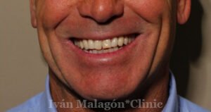 Sonrisa del paciente antes de someterse al tratamiento con Invisalign