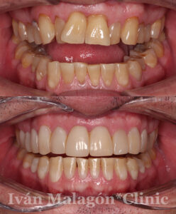 Aspecto de la dentadura del paciente antes y después del tratamiento con Invisalign