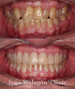 Imagen intraoral de la dentadura del paciente antes y después del tratamiento con invisalign