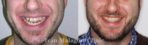 Cambio de la sonrisa del paciente antes y después del tratamiento con Invisalign. 