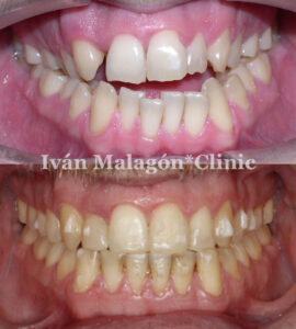 Aspecto frontal de los dientes del paciente antes y después del tratamiento con Invisalign. 