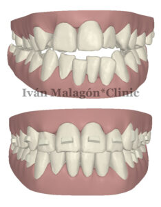 Simulación frontal de los dientes del paciente antes y después del tratamiento con Invisalign con Clincheck. 