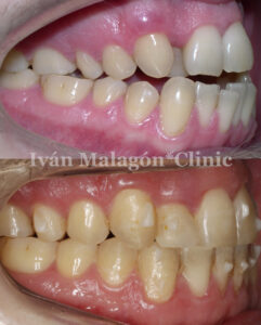 Aspecto lateral de los dientes del paciente antes y después del tratamiento con Invisalign. 