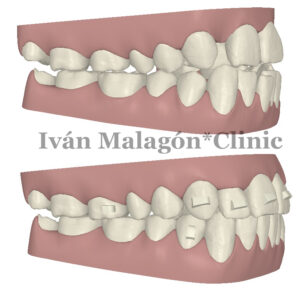 Simulación lateral de los dientes del paciente antes y después del tratamiento con Invisalign con Clincheck. 