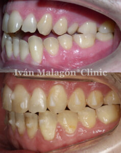 Aspecto lateral de los dientes del paciente antes y después del tratamiento con Invisalign. 