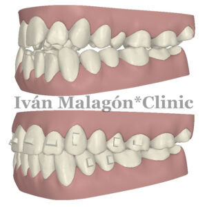 Simulación lateral de los dientes del paciente antes y después del tratamiento con Invisalign con Clincheck. 