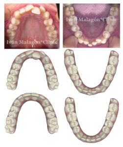 Aspecto de sus dientes antes del tratamiento y predicción mediante Clincheck