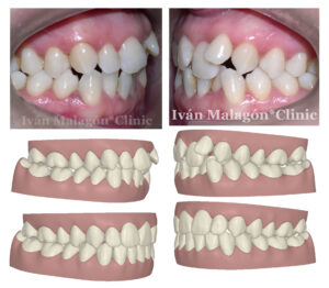 Aspecto de sus dientes antes del tratamiento y predicción mediante Clincheck