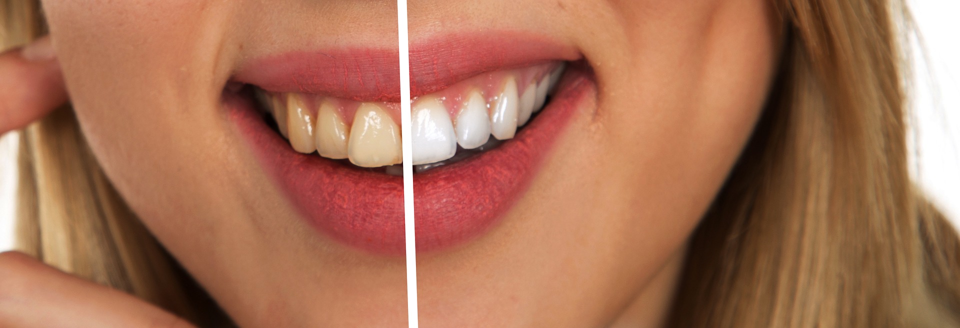 Can I Whiten My Teeth With Invisalign Attachments? 10 Advantages Of Invisalign